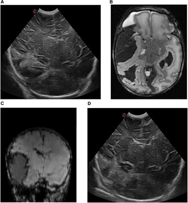 Case Report: resolution of refractory seizures after neurosurgical intervention in newborns with cerebral extra-axial hemorrhages